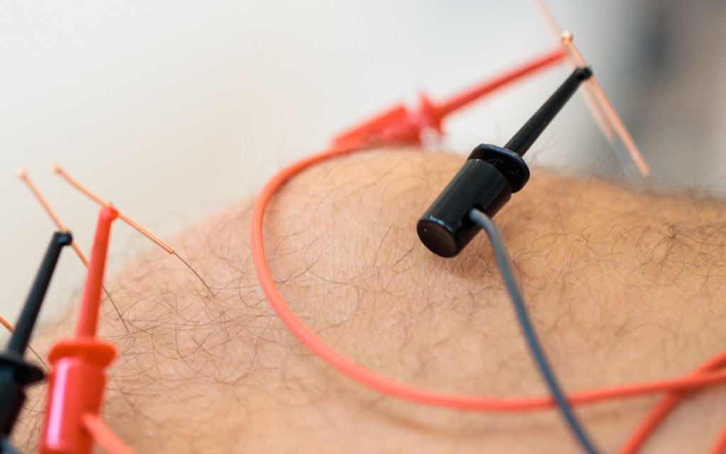Darstellung einer Axomeratherapie an einem Knie mit Nadeln und Elektroden