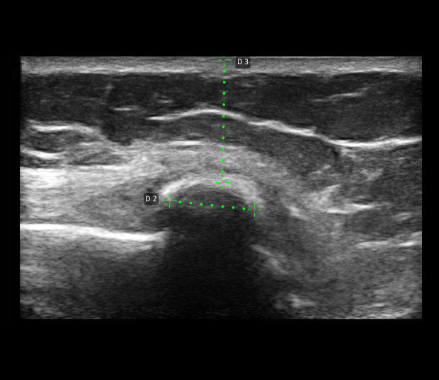 Sonographiebild von einer Stieda-Pellegrini Verkalkung am Innenband des Kniegelenkes